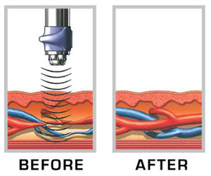 GAINSWave Shockwave Therapy for Erectile Dysfunction