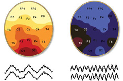 Brainwave Patterns