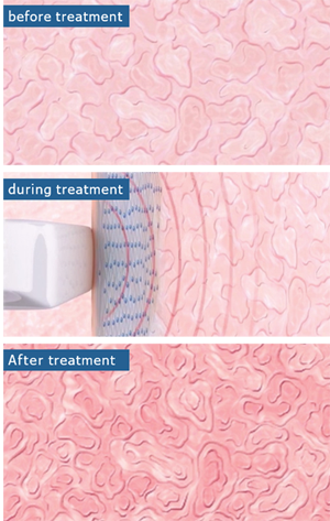 Viveve Treatment Results