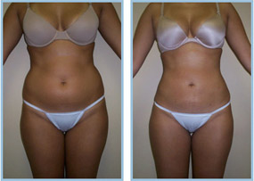 Tickle Lipo Results