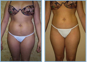 Tickle Lipo Results