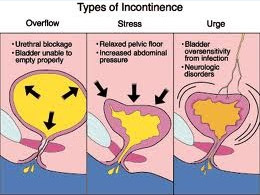 Types of Urinary Incontinence