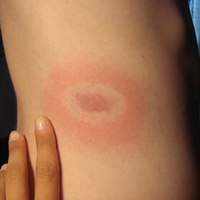 Lyme Disease Doctor San Antonio TX