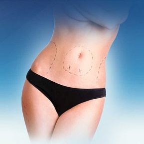 Tickle Lipo San Antonio TX